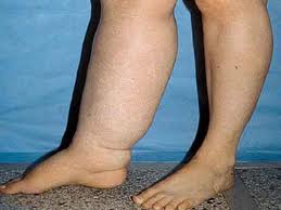 Edema in the right leg