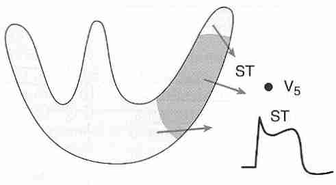 [ Transmural ischemis<br>ST−segment elevation ]